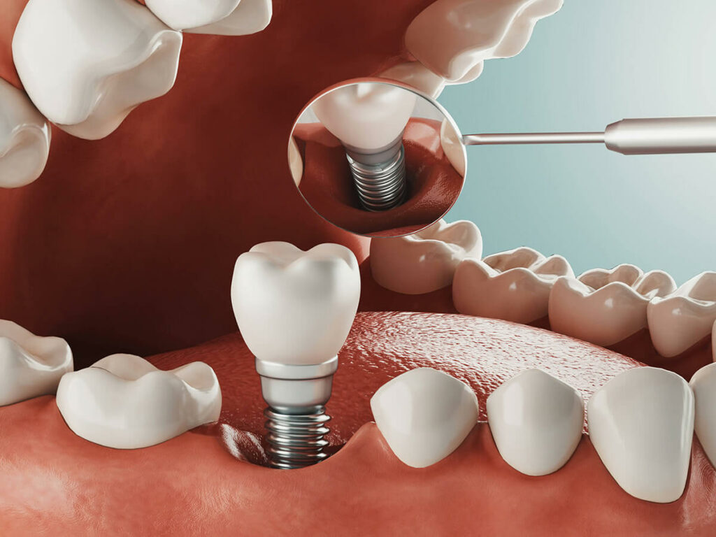 Graphic showing what a dental implant looks like in the mouth.