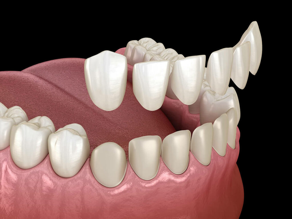 Graphic showing how thin veneer shells are placed ontop of natural teeth.
