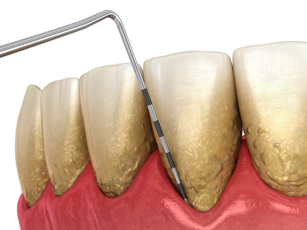 Grapic showing severe plaque buildup on teeth and a tool scaling the gum line.