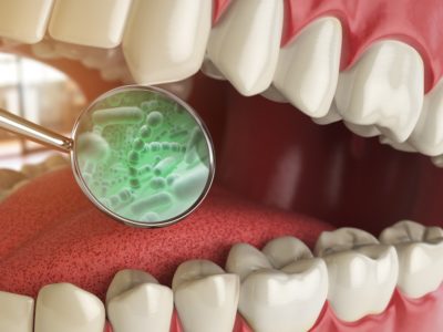 Graphic showing an upclose of a mouth and a dental tool showing green bacteria, representing bad breath.