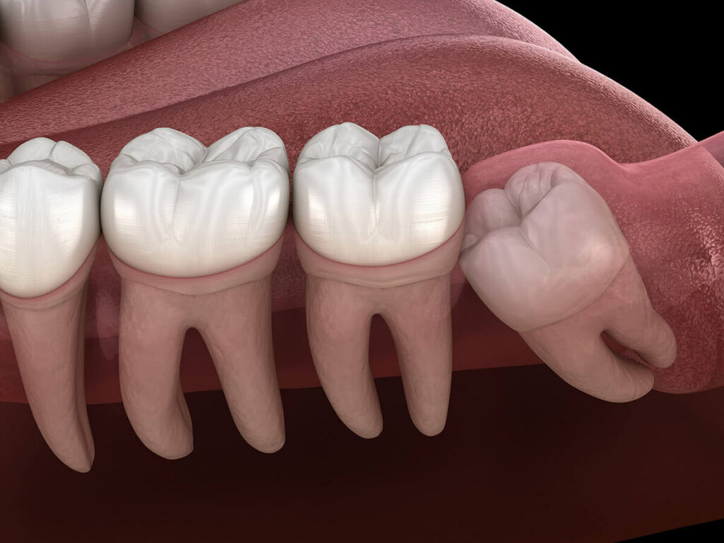 Graphic depicting a wisdom tooth under the surface pushing into another molar.