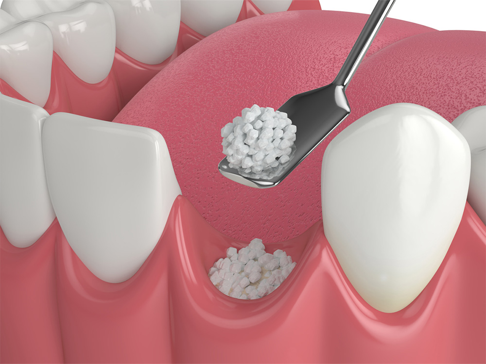 Graphic depicting what a dental bone grafting procedure looks like.